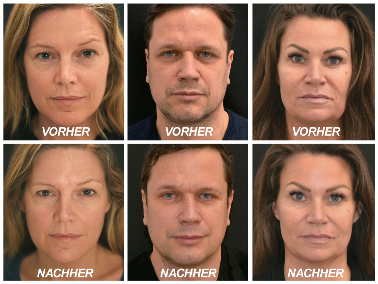 infuzion vorher nachher