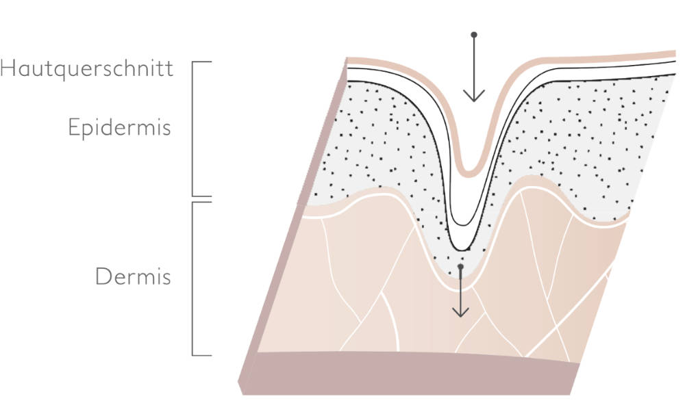 needling