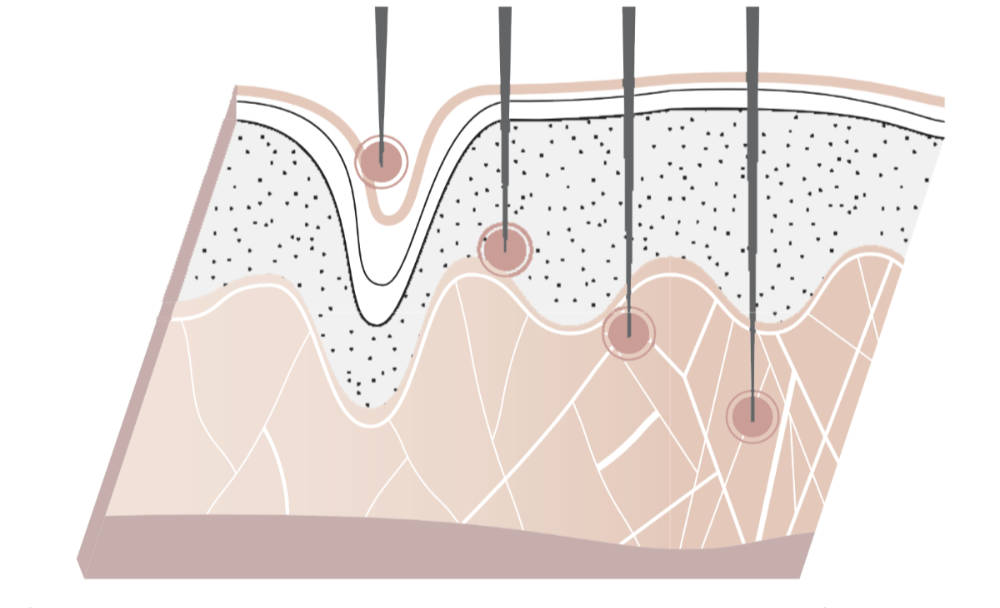 needling